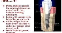 Is implants are like real-teeth