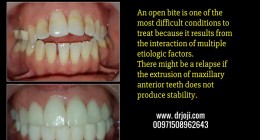 A new approach to open bite treatment